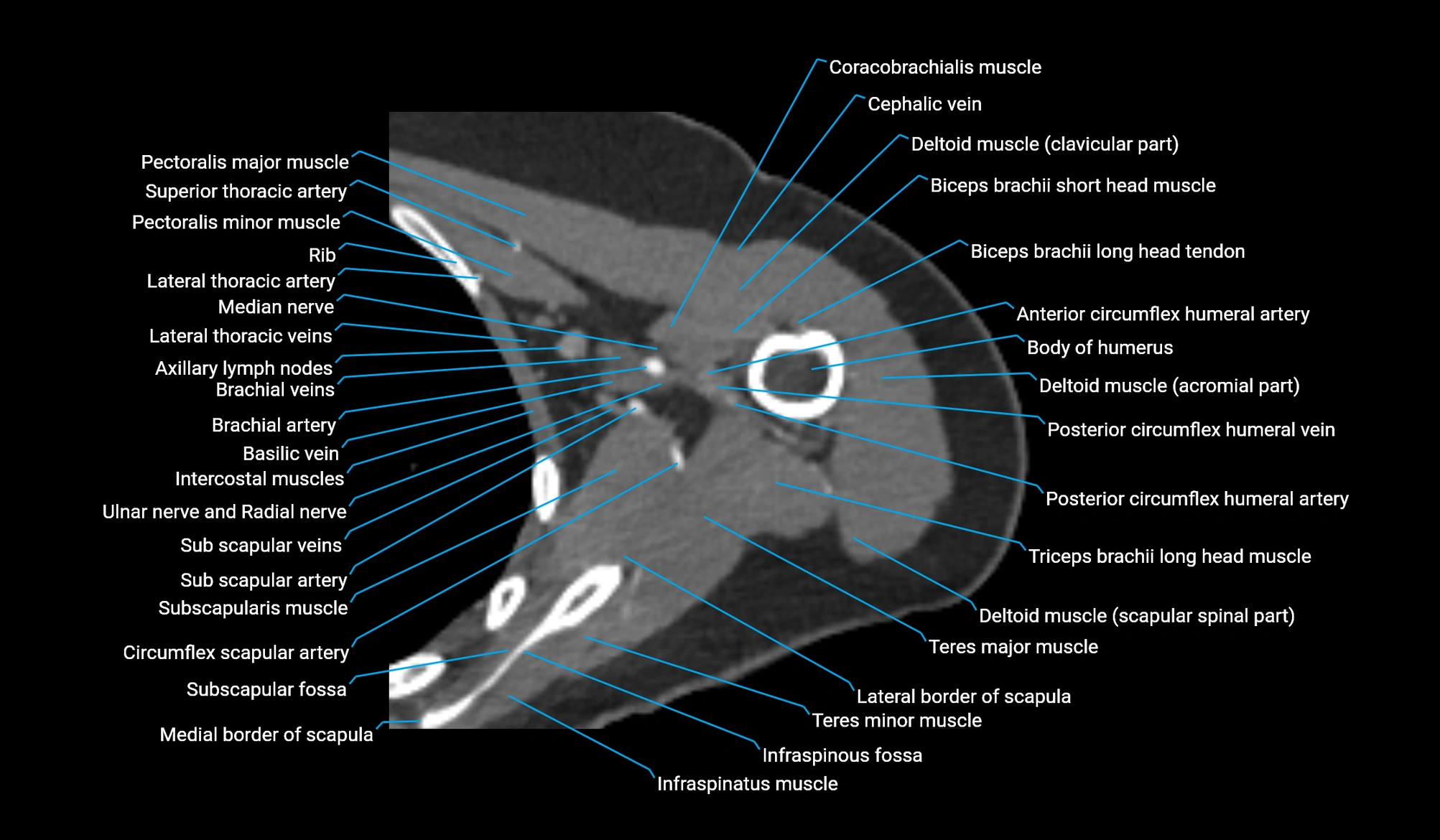 CT upper arm axial  cross sectional anatomy labelled radiology image -00132.webp